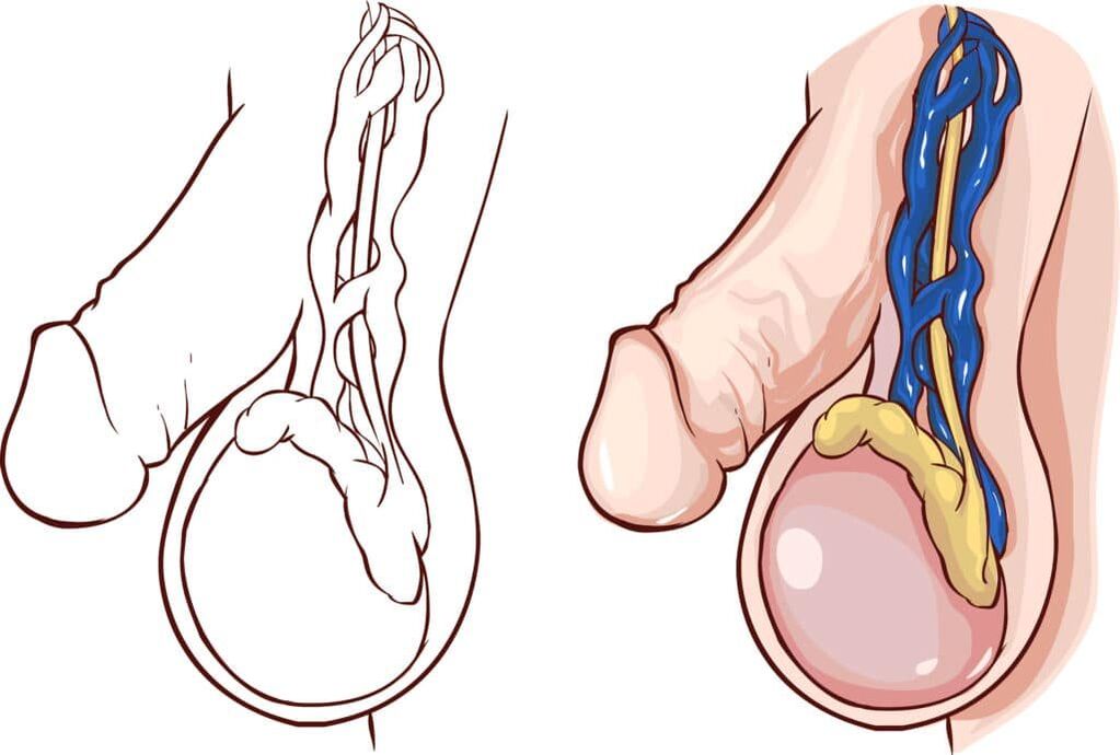 varicocele as a cause of pain in the testicles when aroused